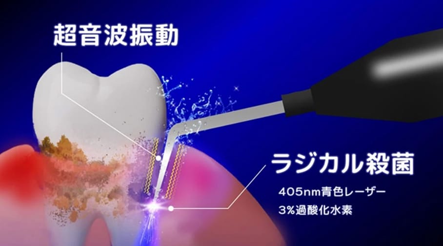 超音波振動と405nm青色レーザー・3%過酸化水素によるラジカル殺菌で歯周ポケット内の歯垢・歯石を除去するブルーラジカル治療の仕組みを示したイラスト図