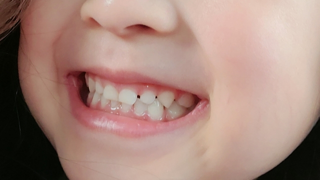 子どもの歯