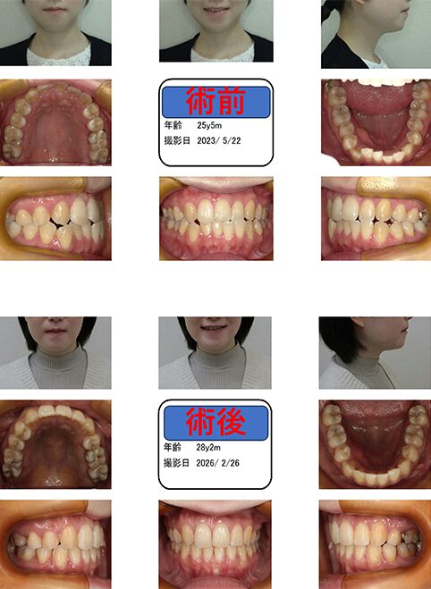 切端咬合の症例|25歳女性
