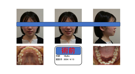 出っ歯・でこぼこの症例｜17歳女性