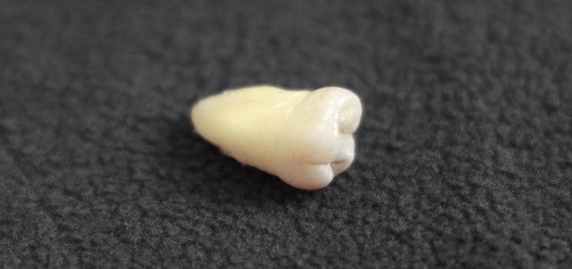 らずの抜歯は難易度がさまざまです