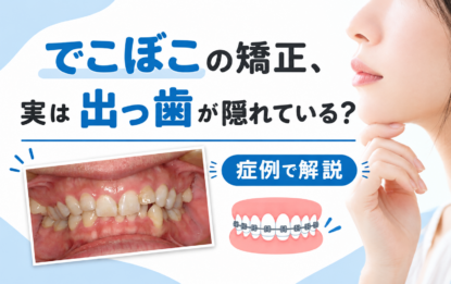 でこぼこの矯正、実は出っ歯が隠れている？症例で解説